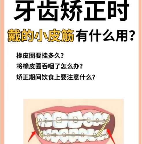 牙齿矫正 牙齿矫正