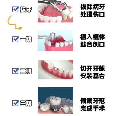 牙齿种植 牙齿种植