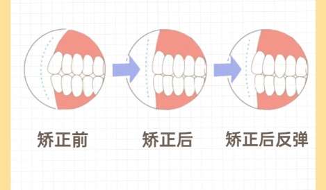 牙齿矫正 牙齿矫正