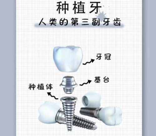 牙齿种植 牙齿种植