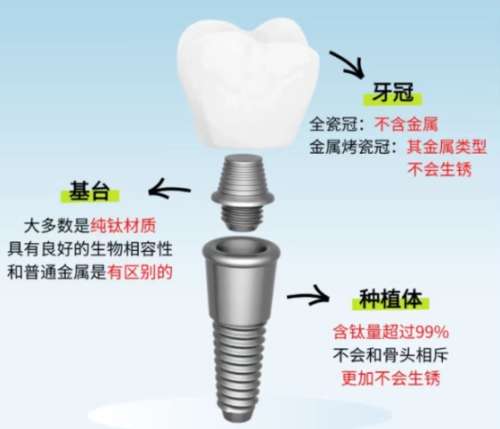 牙齿种植 牙齿种植