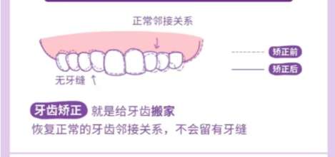 牙齿矫正 牙齿矫正
