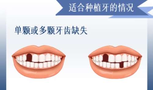 牙齿种植 牙齿种植