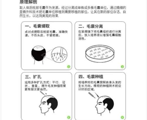 植发 植发