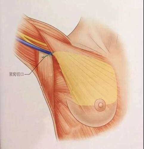 隆胸腋窝切口.jpg