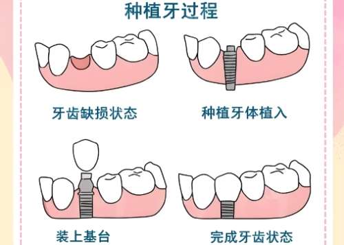 牙齿种植 牙齿种植