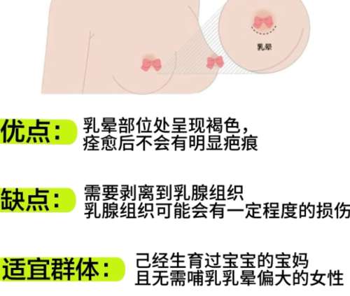隆胸.jpg 隆胸.jpg