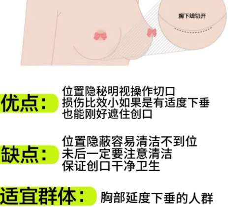 隆胸 隆胸