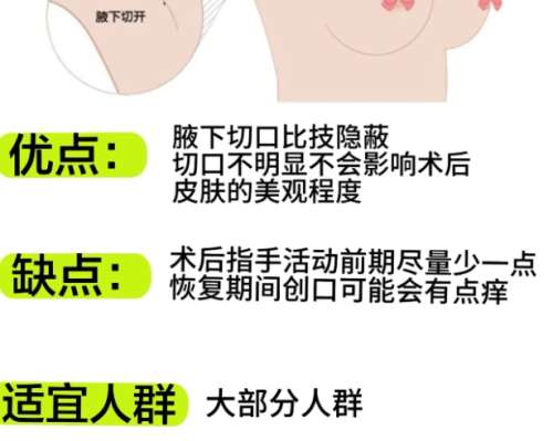隆胸 隆胸
