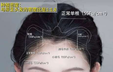 植发xx1.jpg