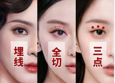 双眼皮 双眼皮