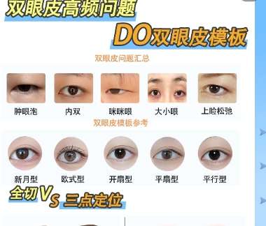 双眼皮 双眼皮