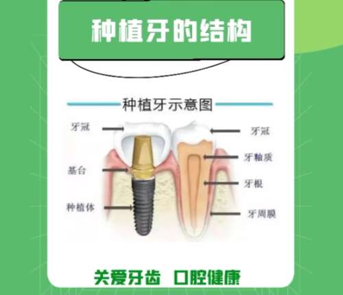牙齿种植