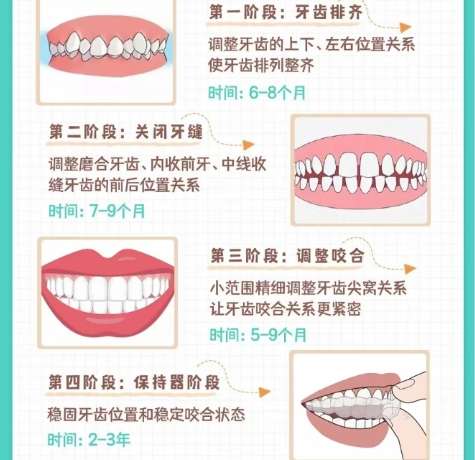 牙齿矫正 牙齿矫正