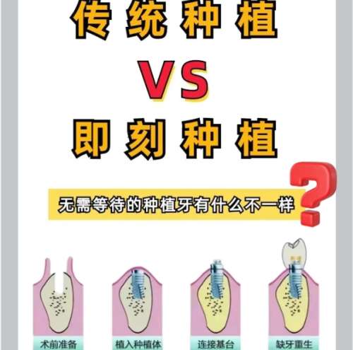 牙齿种植 牙齿种植