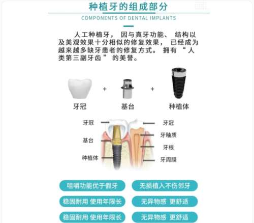 牙齿种植 牙齿种植