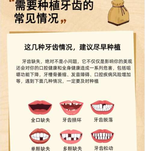 牙齿种植 牙齿种植