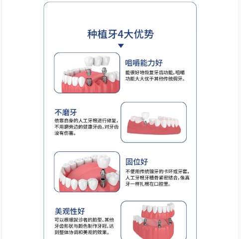 牙齿种植