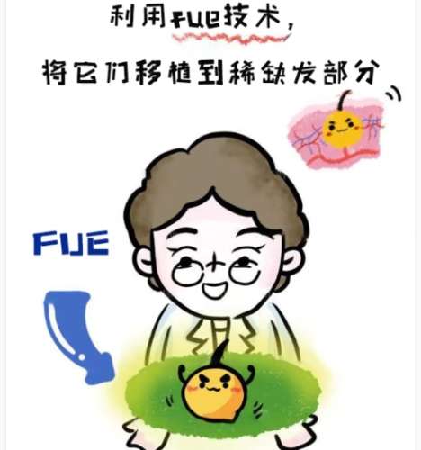 植发 植发