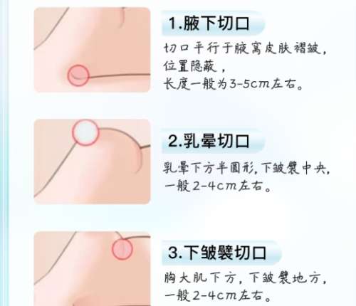 隆胸