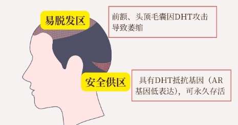 植发 植发