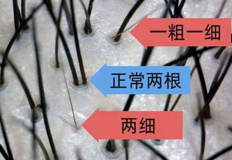 植发 植发