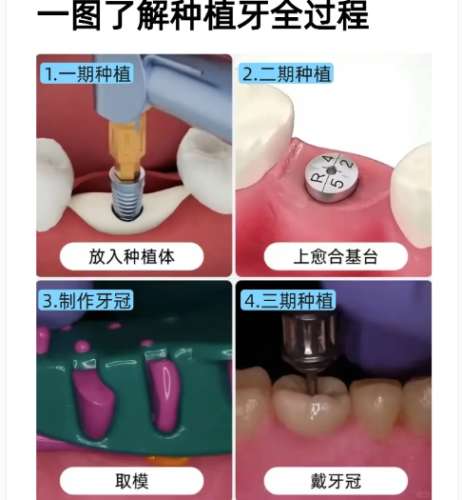牙齿种植 牙齿种植