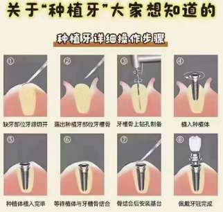 牙齿种植