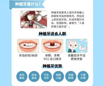 牙齿种植 牙齿种植