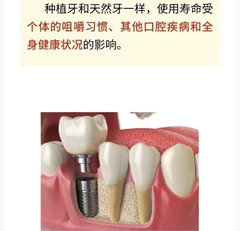 牙齿种植 牙齿种植