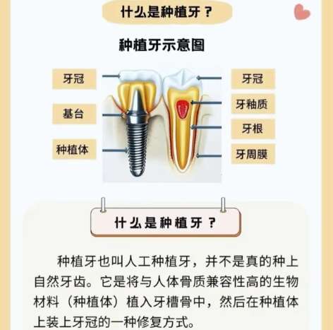 牙齿种植
