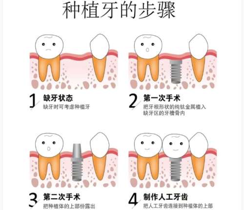 牙齿种植