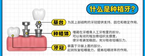 牙齿种植 牙齿种植