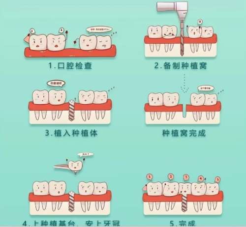牙齿种植 牙齿种植