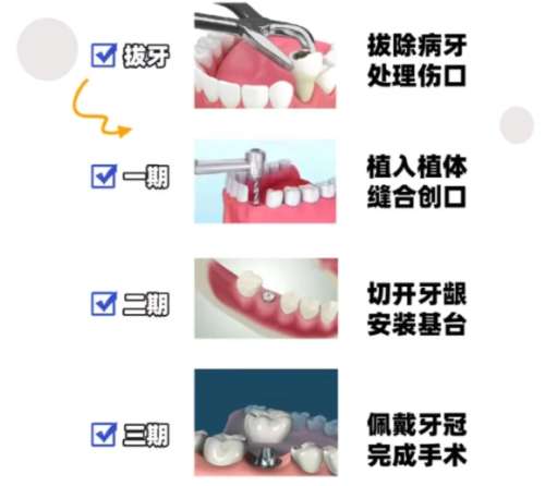 牙齿种植 牙齿种植