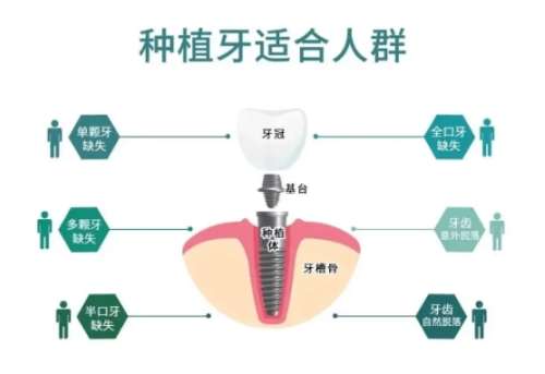 牙齿种植 牙齿种植