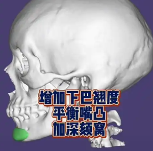 上海peek下巴在哪做？美立方\联合丽格\天大等4家机构测评，含26年价格